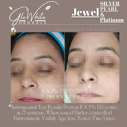 Skin whitening treatment kit results, split-face before and after on cheeks and forehead