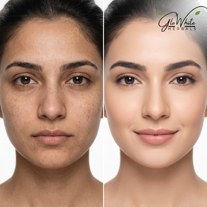Before-and-after forehead close-up: freckles and pigmentation on left, smooth bright skin on right, GloWhite Herbals